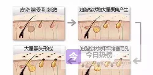 黑头终结者：科学去黑头全攻略