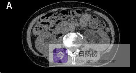 输尿管夹层：从发病到CT识别的全链条解析