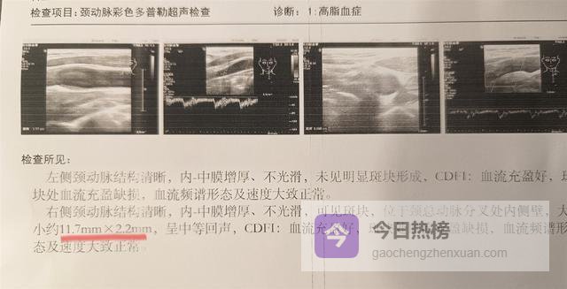 医生提醒：查出颈动脉斑块多年未脑梗的人，基本日常坚持6个习惯