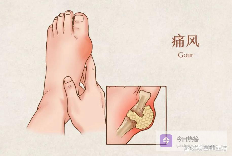 再次提醒：这6种食物是“尿酸杀手”，痛风人群尽量少吃，别不信！